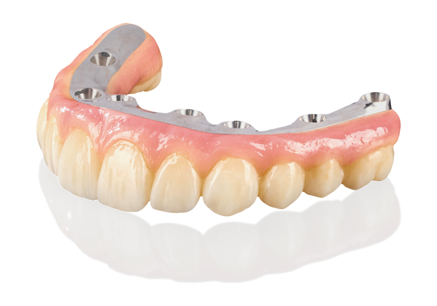 Phục Hình Trên Implant