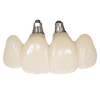 Cemented Implant Crown & Bridge