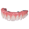 Implant-Retained Hybrid Dentures
