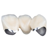 Phục Hình Sứ Kim Loại PFM