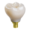 Screw-Retained Implant Crown & Bridge