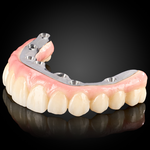 Full Arch Implant Prosthesis