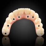 Full Arch Implant Prosthesis