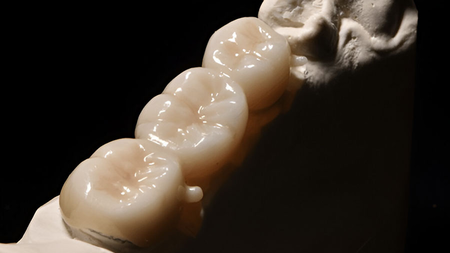 In-Ceram Zirconia: Hướng Dẫn Toàn Diện Về Sứ Alumina Gia Cường Zirconia Thấm Thủy Tinh