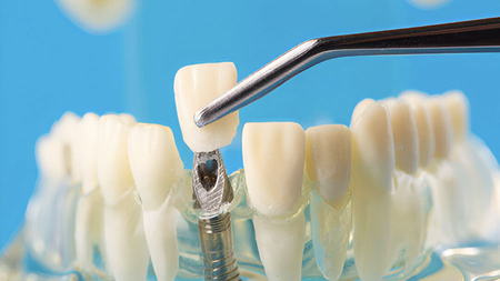 Vì Sao Hệ Thống Sứ Alumina Vẫn Còn Giá Trị Trong Phục Hình Nha Khoa Hiện Đại