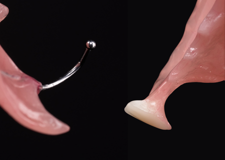 Acrylic Removable Partial Denture