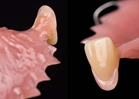Acrylic Removable Partial Denture