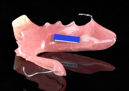 Acrylic Removable Partial Denture