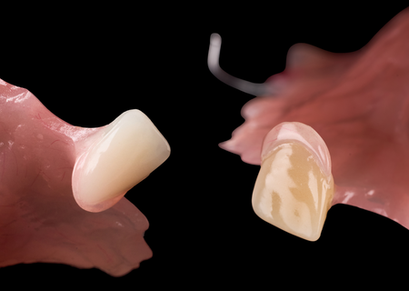 Acrylic Removable Partial Denture