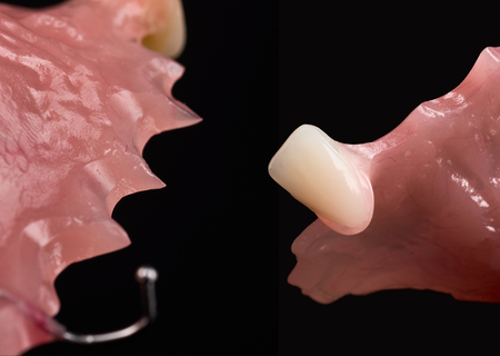 Acrylic Removable Partial Denture