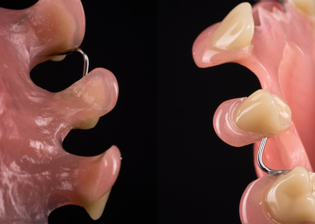 Acrylic Removable Partial Denture