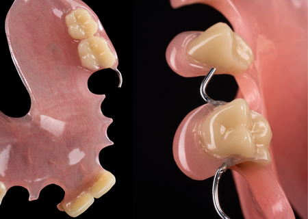 Acrylic Removable Partial Denture