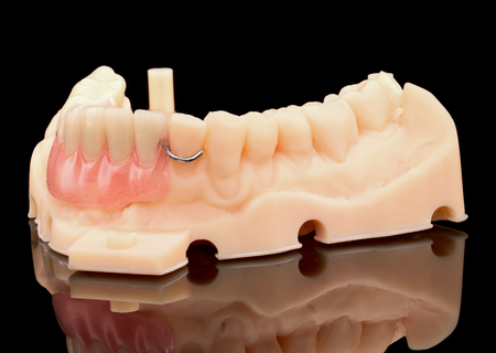 Acrylic Removable Partial Denture