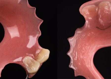 Acrylic Removable Partial Denture