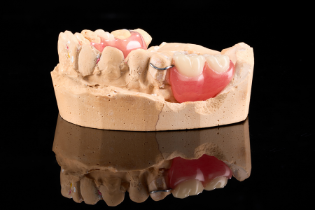 Partial Denture