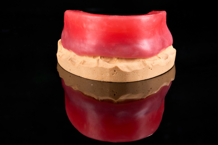 Partial Denture