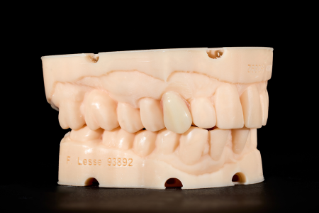 Partial Denture
