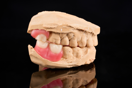 Partial Denture