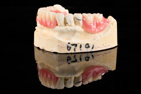 Partial Denture