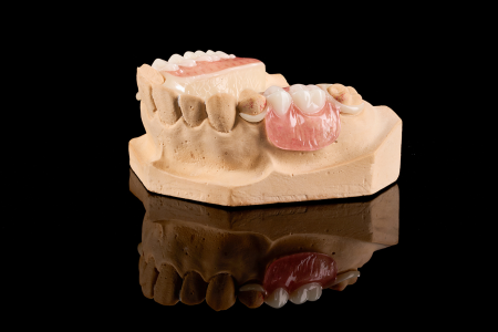 Partial Denture