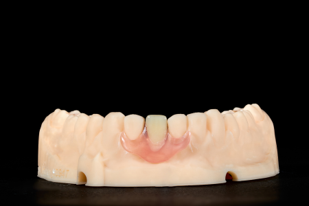 Partial Denture