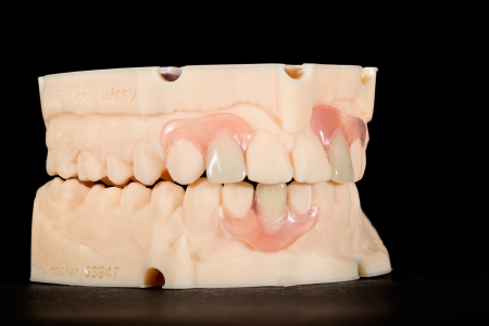 Partial Denture