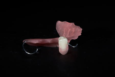 Partial Denture