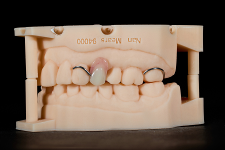 Partial Denture