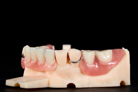 Partial Denture