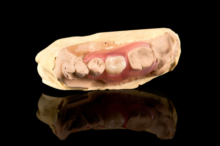 Partial Denture
