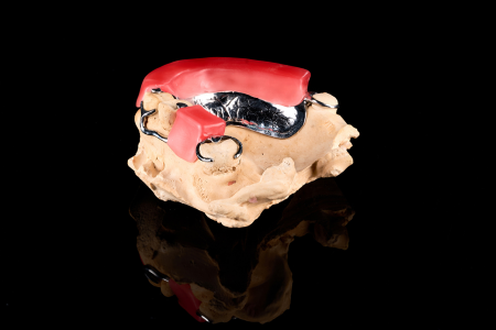Partial Denture