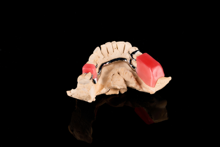 Partial Denture