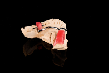 Partial Denture