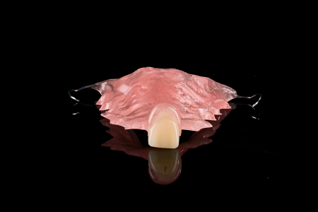 Partial Denture