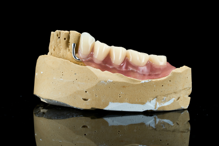 Partial Denture