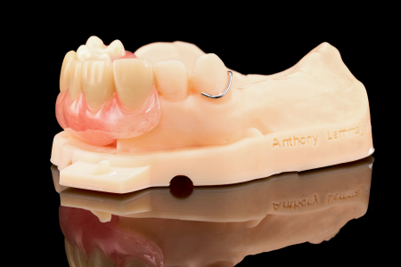 Partial Denture