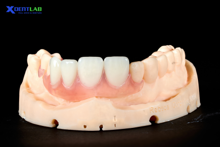 Partial Denture