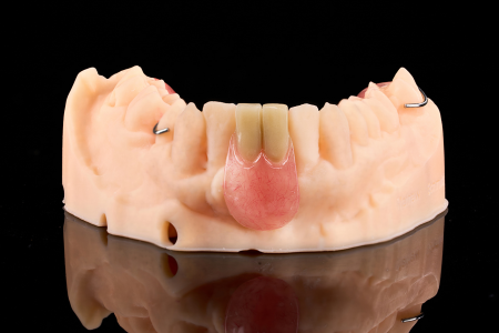 Partial Denture