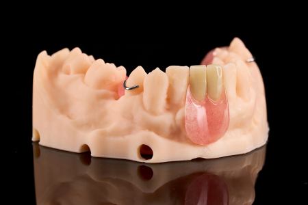 Partial Denture