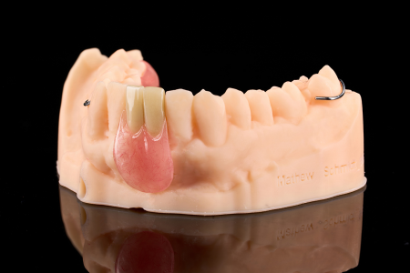 Partial Denture