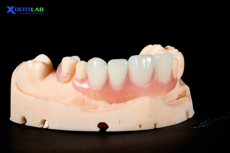 Partial Denture
