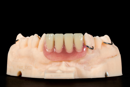 Partial Denture