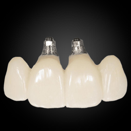 Phục Hình Cầu Và Mão Lẻ Trên Implant Phục Hình Cầu Và Mão Lẻ Trên Implant