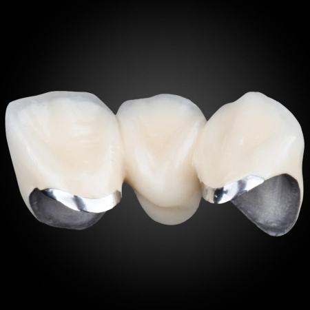 PFM – Porcelain Fused Metal Dental Crown PFM – Porcelain Fused Metal Dental Crown