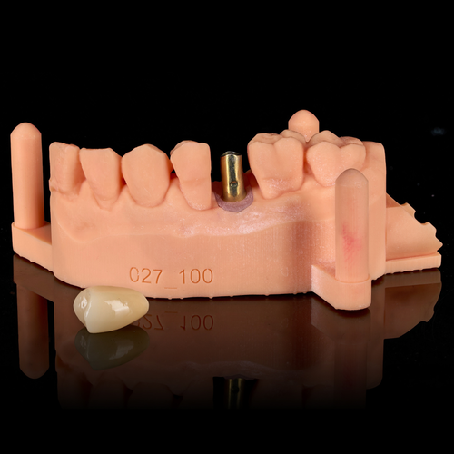 Cement-Retained Implant Crown & Bridge