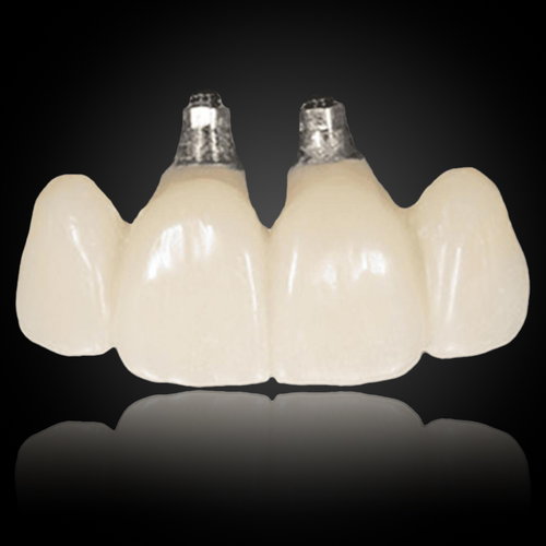 Cemented Implant Crown & Bridge Cemented Implant Crown & Bridge