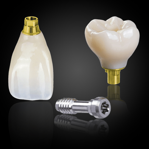 Screw-Retained Implant Crown & Bridge Screw-Retained Implant Crown & Bridge