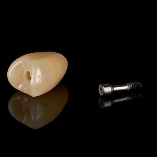 Screw-Retained Implant Crown & Bridge