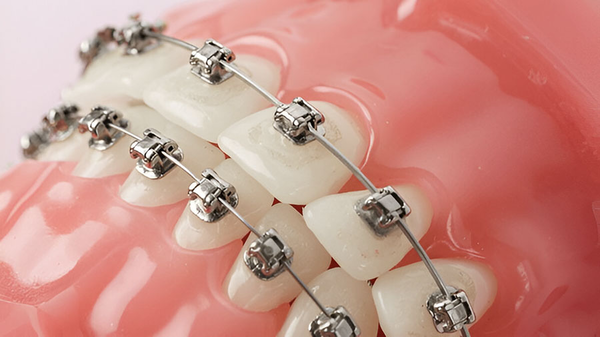 Mắc Cài Thép Không Gỉ: Những Điều Cần Biết