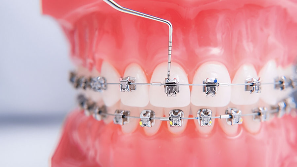 Các Loại Vật Liệu Mắc Cài Chỉnh Nha Các Loại Vật Liệu Mắc Cài Chỉnh Nha